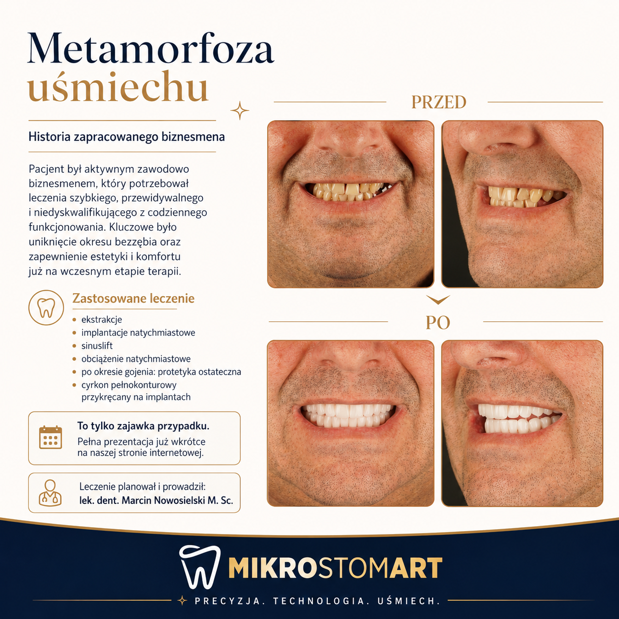 Metamorfoza uśmiechu — przed i po pełnej odbudowie na implantach, Mikrostomart Opole